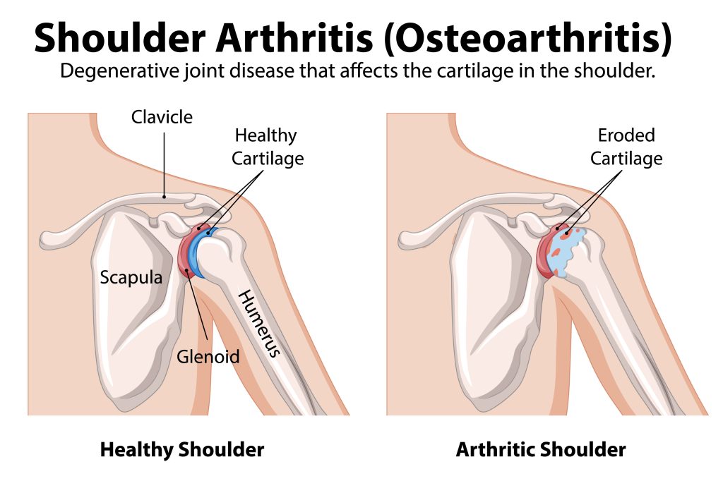 Osteoporosis vs Osteoarthritis, Apa Bedanya? 2 Osteoarthritis ilustrasi