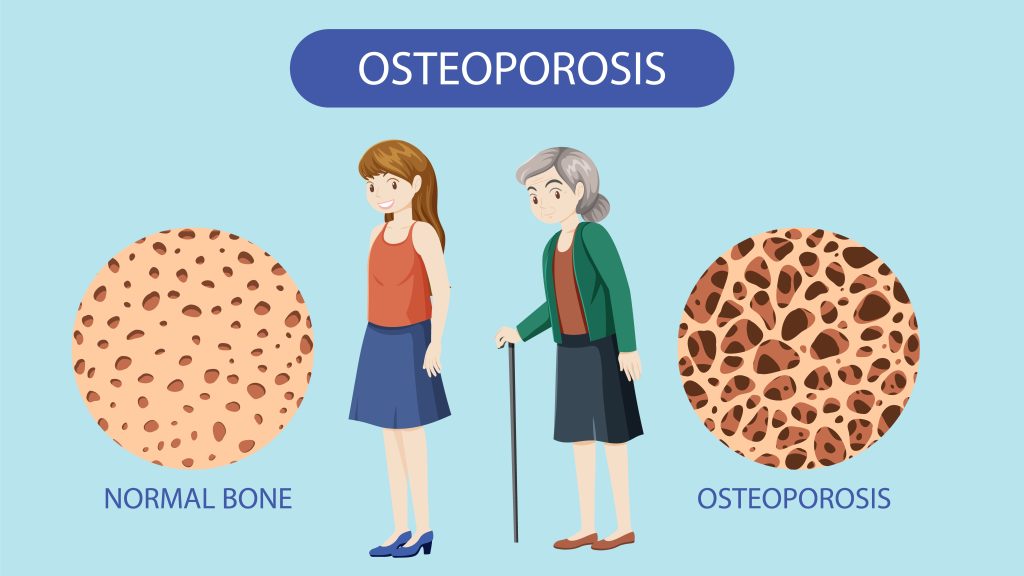 Osteoporosis vs Osteoarthritis, Apa Bedanya? 1 Osteoporosis ilustrasi