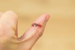 Tips Perawatan Luka Diabetes yang Perlu Diketahui