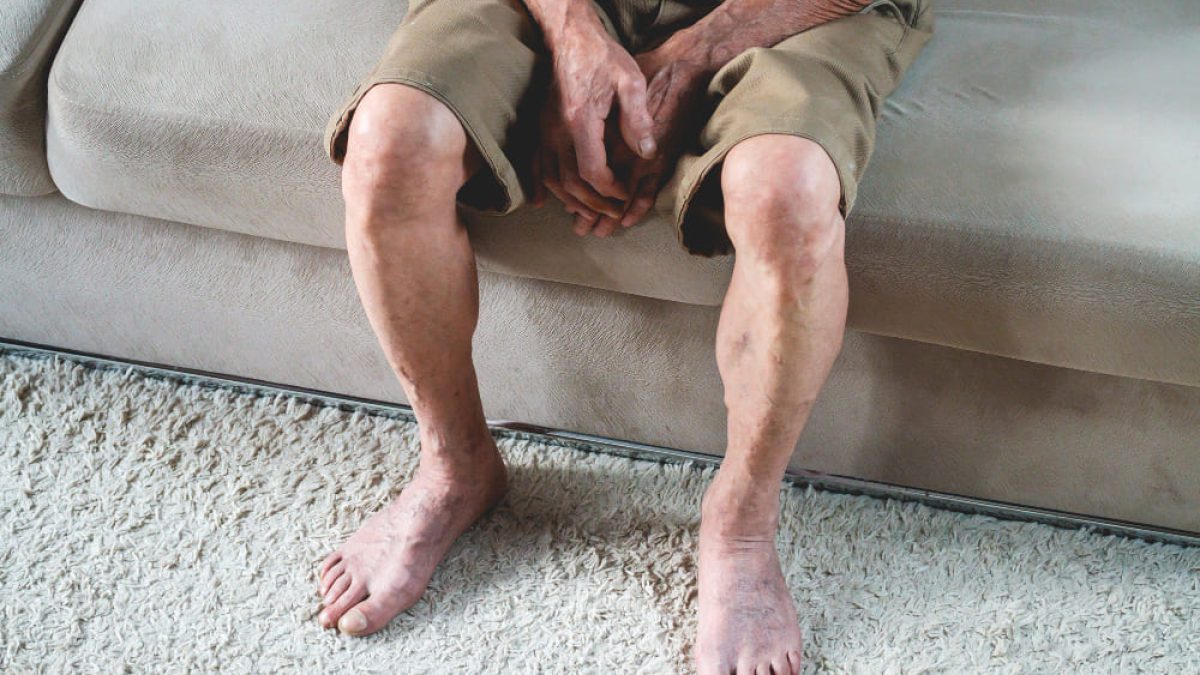 5 Penyebab Kaki Bengkak Pada Lansia Dan Cara Mengatasinya